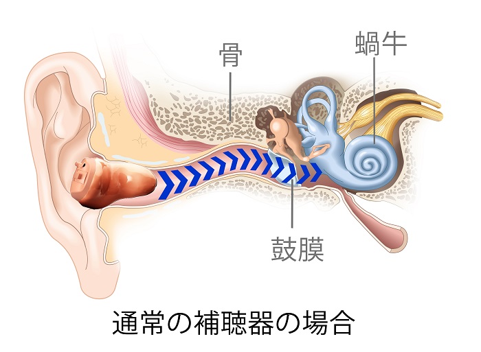 通常の補聴器の空気の振動が分かる耳の断面図