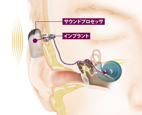 骨固定型補聴器